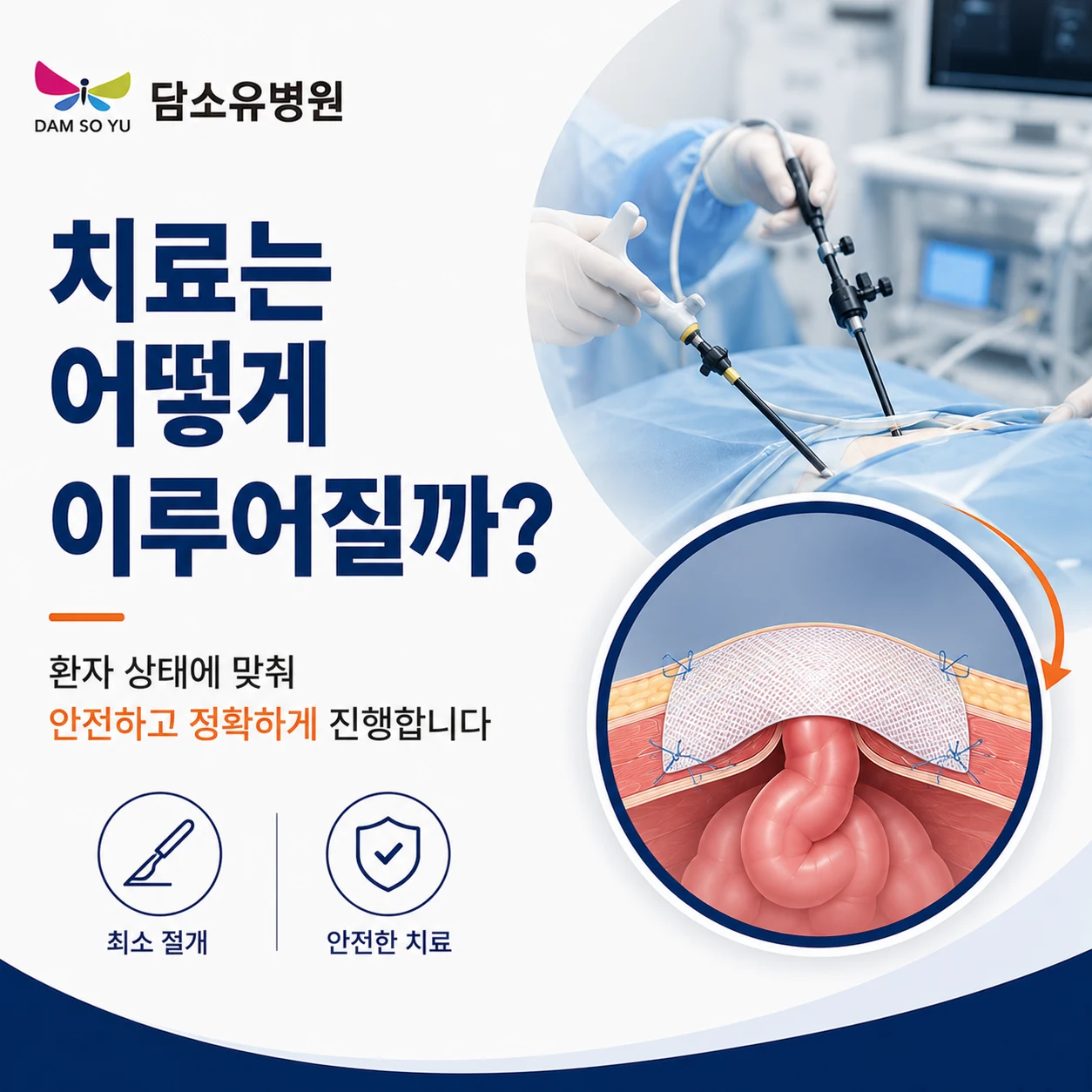 한쪽 탈장이 발견되면 반대쪽도 살펴봐야 할까요?